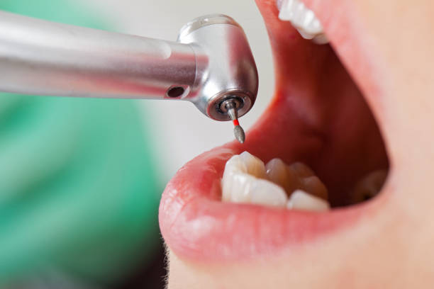 Best Emergency Tooth Extraction in Temelec, CA